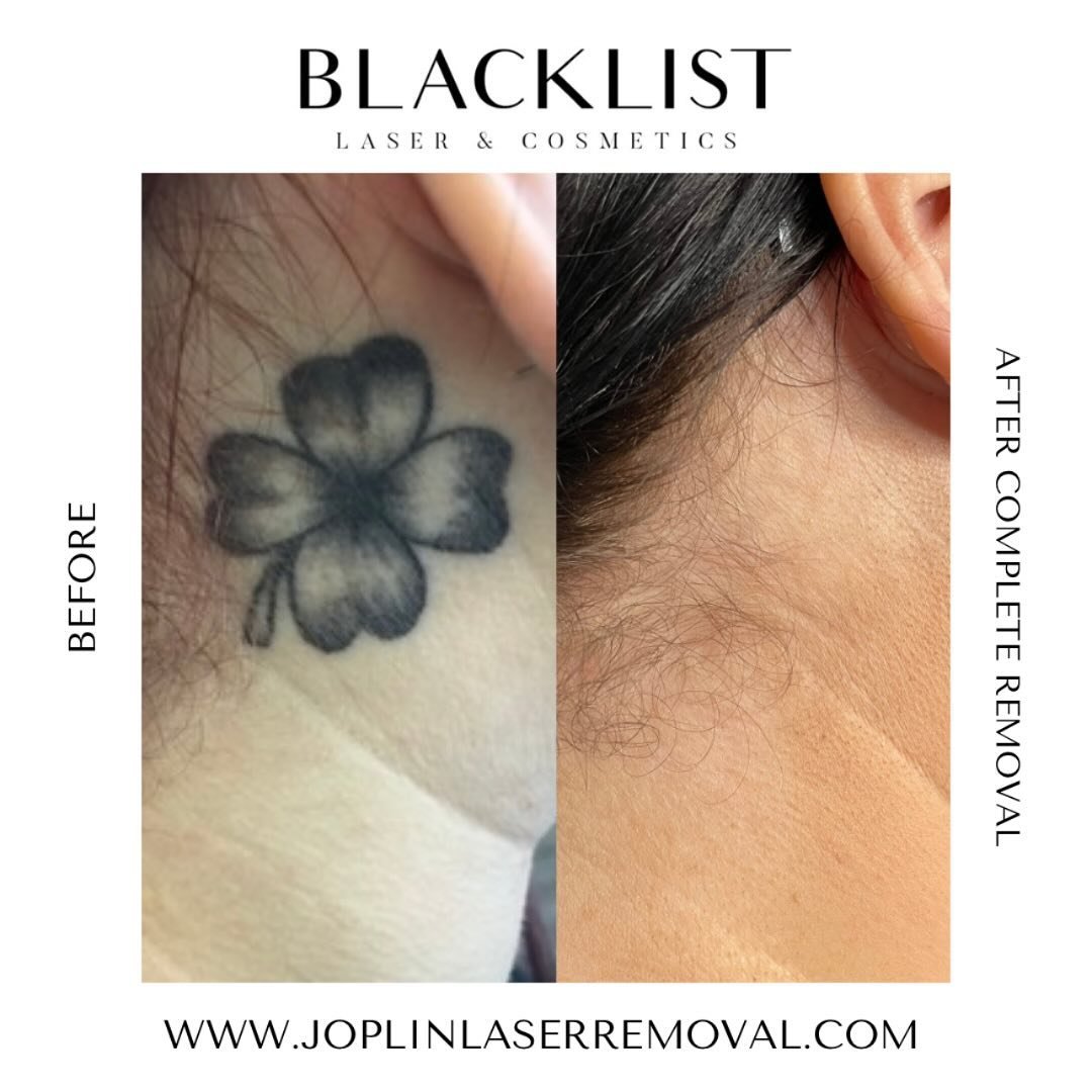 It&rsquo;s always a good day when someone tells you that you removed a tattoo for them and you couldn&rsquo;t even tell what or where it was without the before! Loved seeing these results!