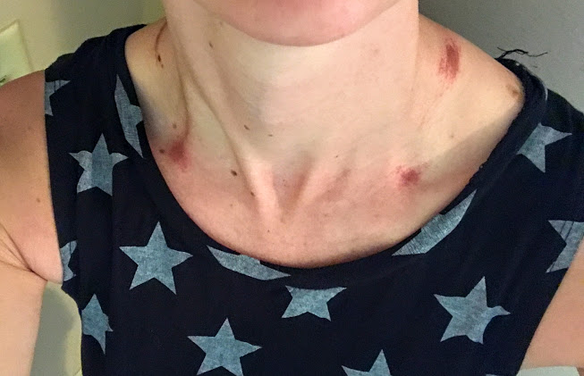 Ouchie mama! Chafing from my pack. Not the right one for me, obviously.