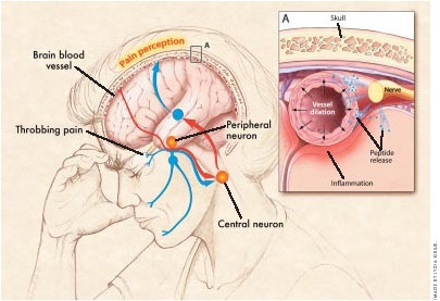 New Hope for Migraines