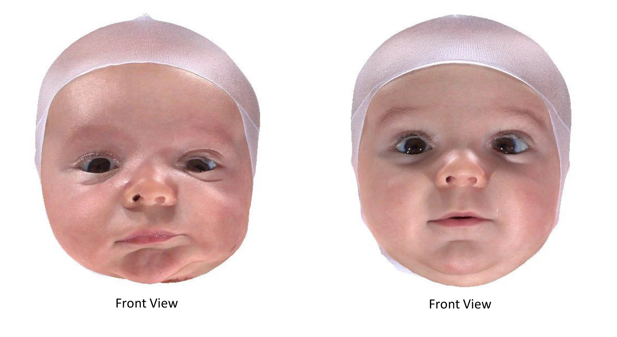 torticollis and flat head