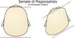 Plagiocephaly.png