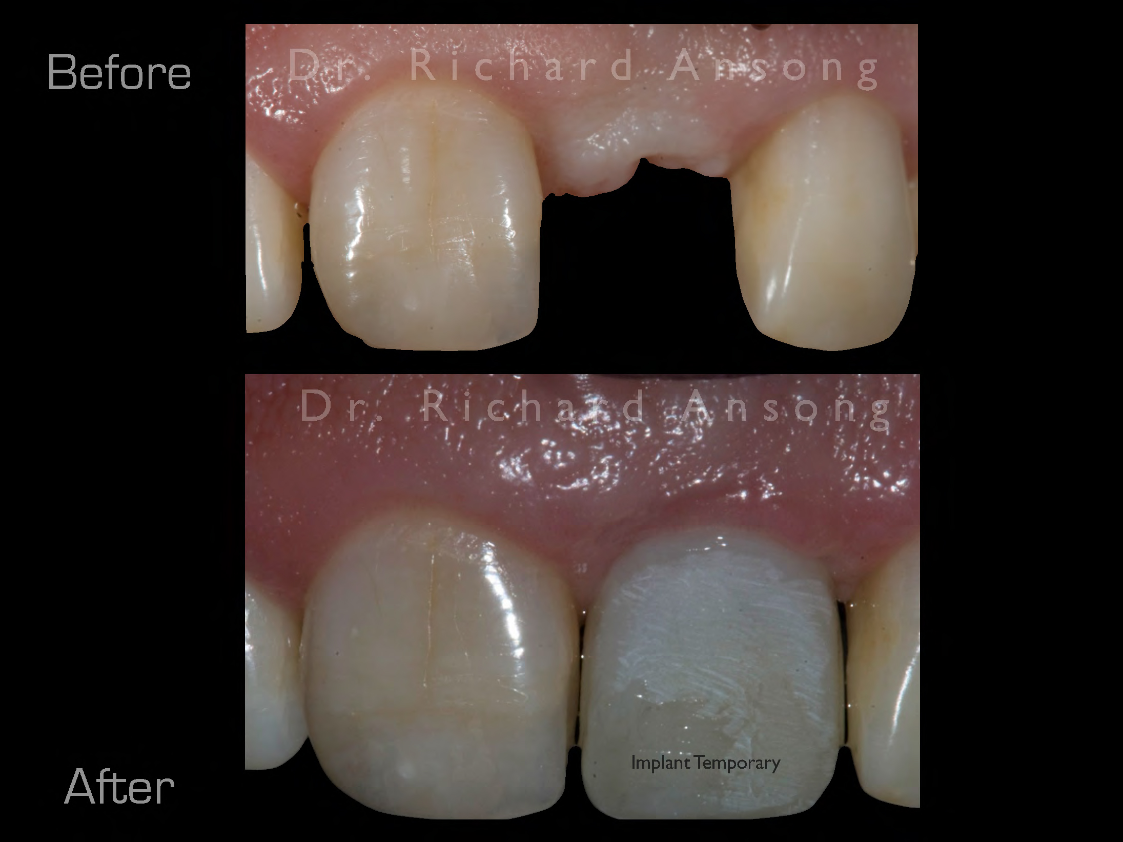 redmond-cosmetic-dentistry-before-after-1.jpg