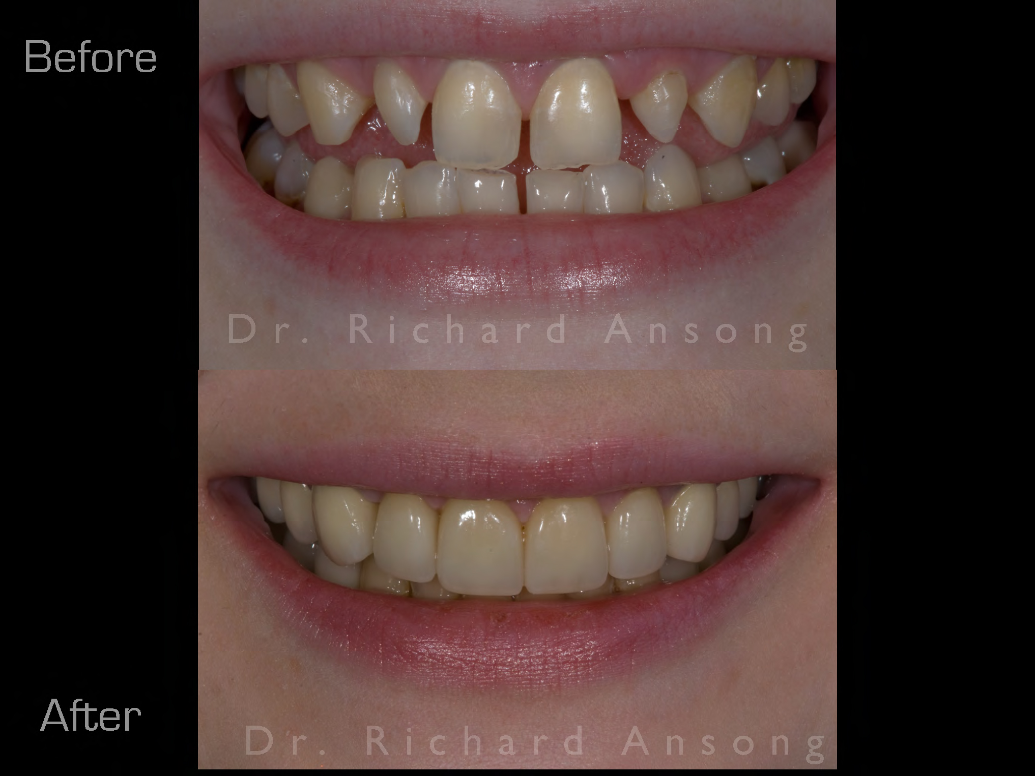 redmond-cosmetic-dentistry-before-after.jpg