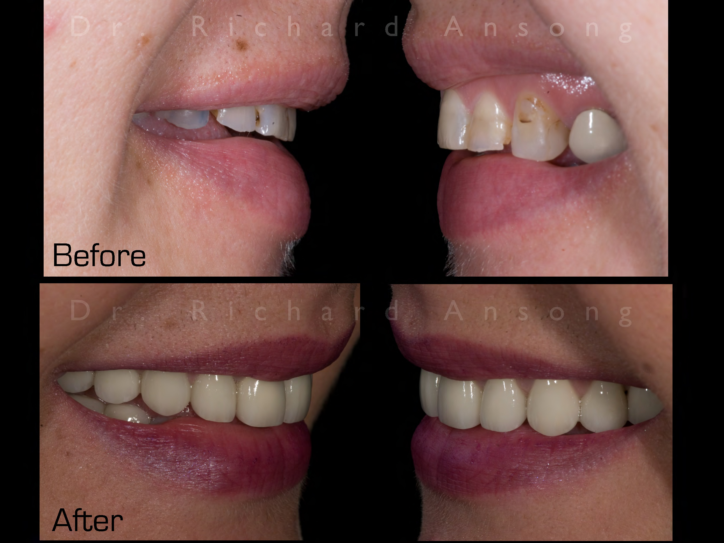 redmond-cosmetic-dentistry-before-after-3.jpg