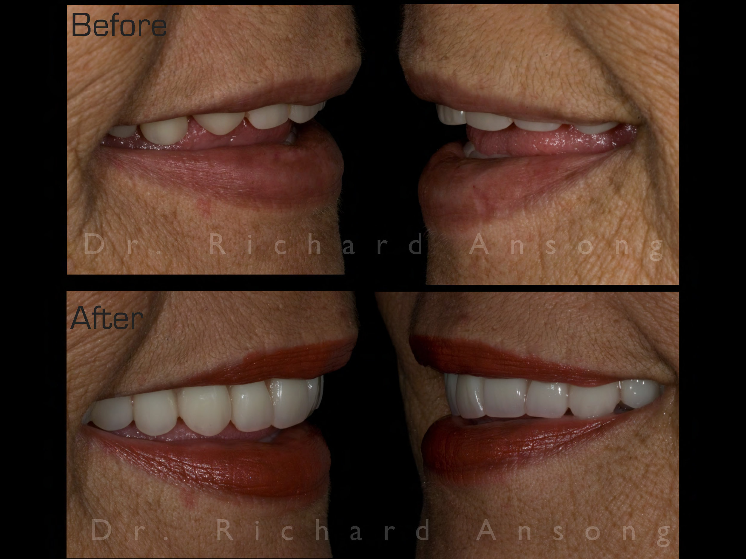 redmond-cosmetic-dentistry-before-after-2.jpg