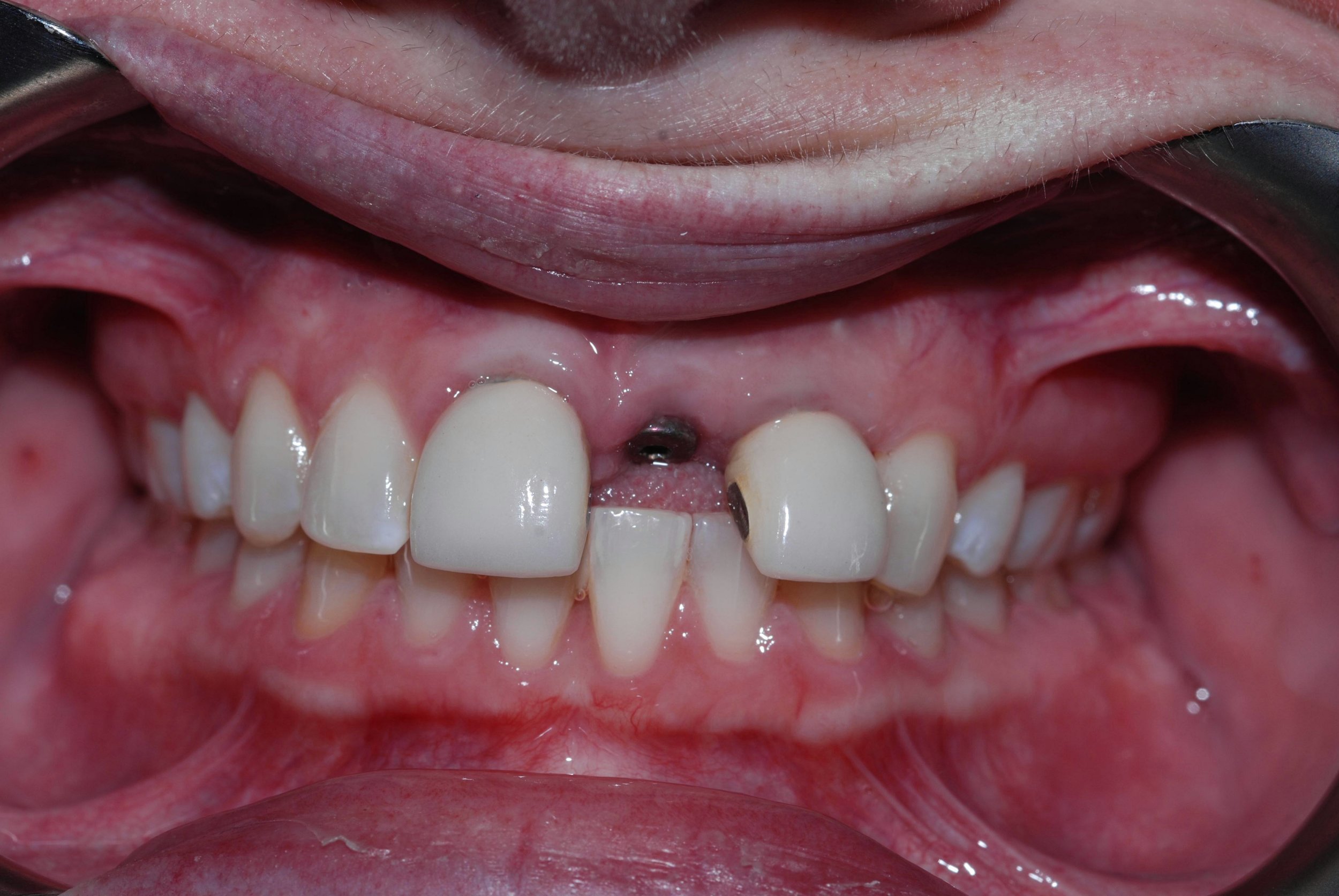 redmond-washington-dental-implants-before-belred-dentist.JPG