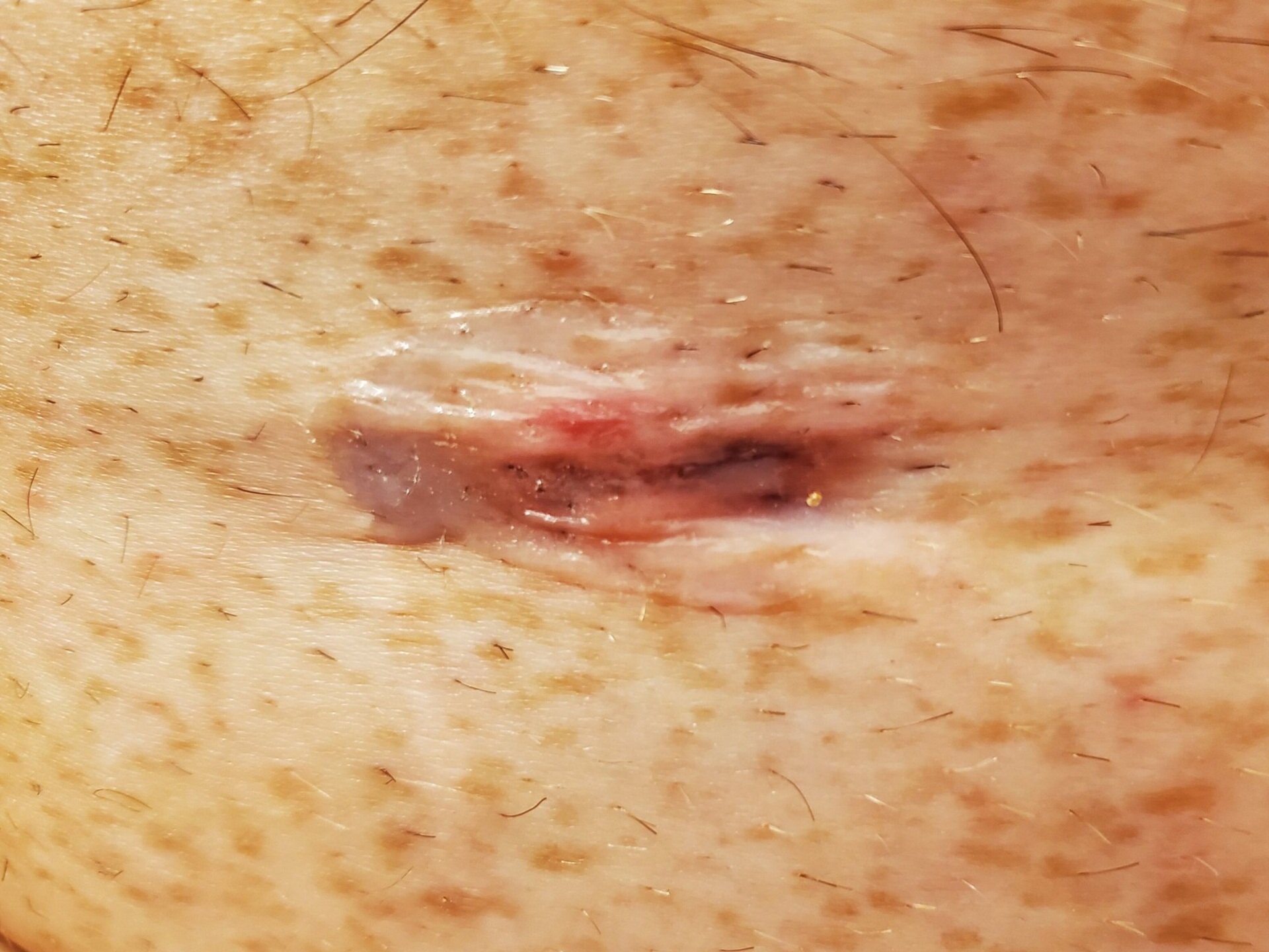Close up of the incision.