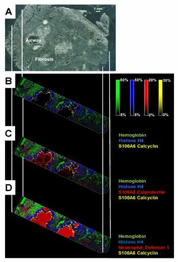 Figure 1. (A) Image of CF human lung with trichome staining prior to IMS acquisition. CF human lung at 30 µM using the RapifleX MALDI Tissuetyper, on linear positive ion mode. (B) Overlay: m/z 15,125.74 (hemoglobin, green), m/z 11,305.05 (histone H4, blue), m/z 10,095.5 (calcyclin, yellow). (C) Overlay: m/z 15,125.74 (hemoglobin, green), m/z 11,305.05 (histone H4, blue), m/z 10834.93 (S100A8, red), m/z 10,095.5 (calcyclin, yellow). (D) Overlay: m/z 15,125.74 (hemoglobin, green), m/z 11,305.05 (histone H4, blue), m/z 3450 (neuthrophil defensing 1, red), m/z 10,095.5 (calcyclin, yellow). Pixels are beam scanned with a 30 x 30 pixel. 141,000 pixels were acquired in about 1.5 hrs. Scale bar 1mm.