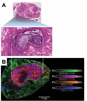 Figure 3. (A) H&E histology of CF human lung (right lower lobe). The inflamed airspace is shown enlarged (inset, gram stained). Optical images obtained at x 20 magnification using a Leica SCN400 Brightfield Slide Scanner. (B) CF human lung at 50 µM using the RapifleX MALDI Tissuetyper, on linear positive ion mode. Overlay: m/z 4,132.222 (green), m/z 4,048.831 (pink), m/z 2,534 (orange), and m/z 2,451 (blue). 100 shots/pixel in 20 µm steps, 4537 positions.