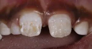 Weak tooth enamel is a huge problem in our children eating a modern diet of processed foods, refined sugars and grains.