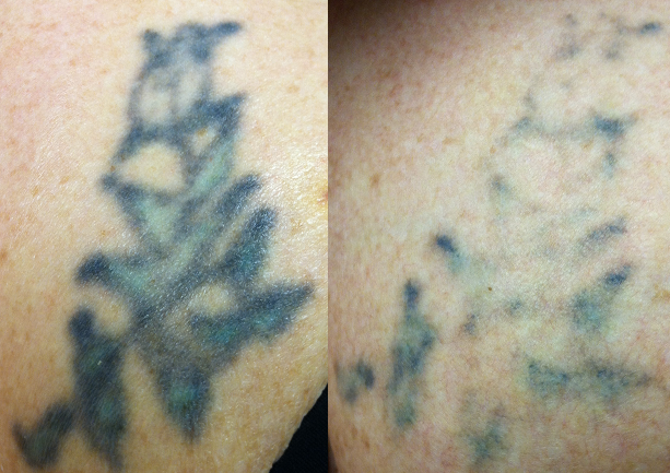 Before and After 2 PicoSure Treatments