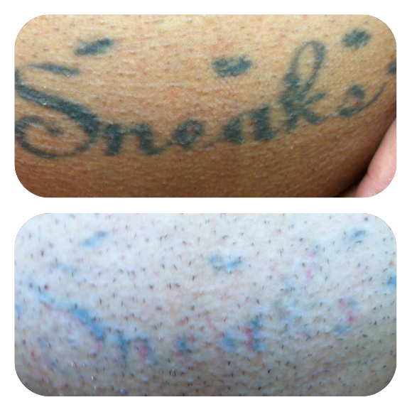 PicoSure Tattoo Removal
