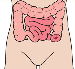 Colostomy.jpg