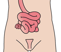 Ileostomy.jpg