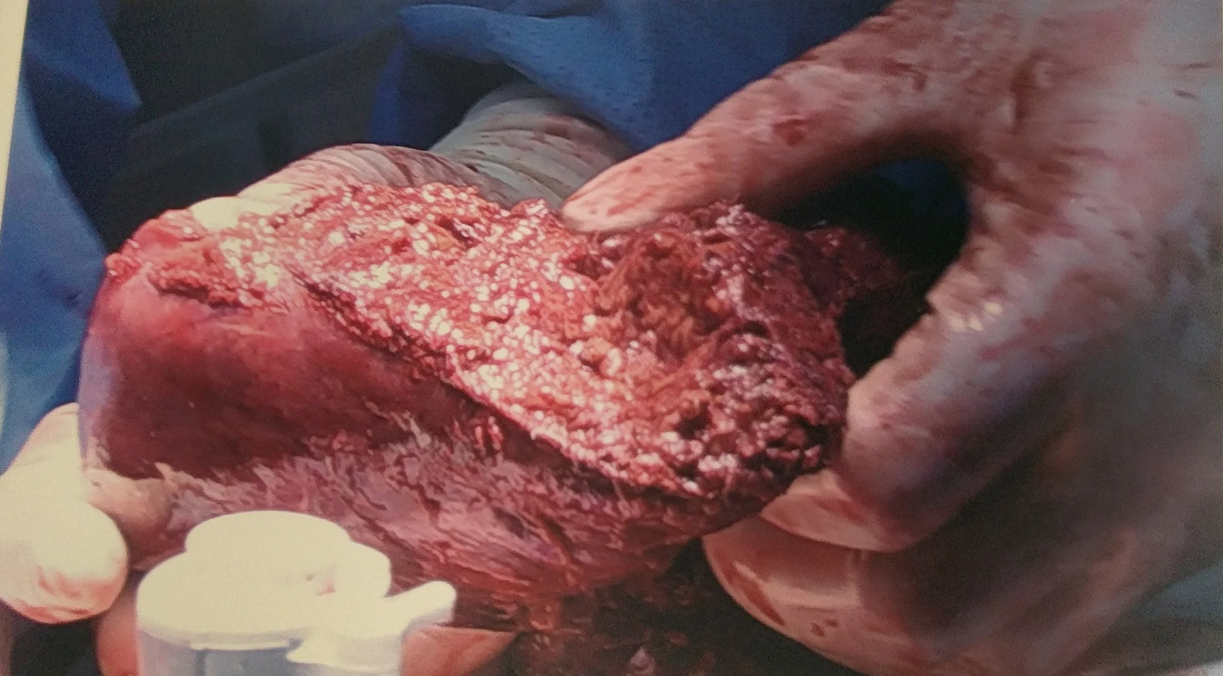 The chunk of liver they cut out of me