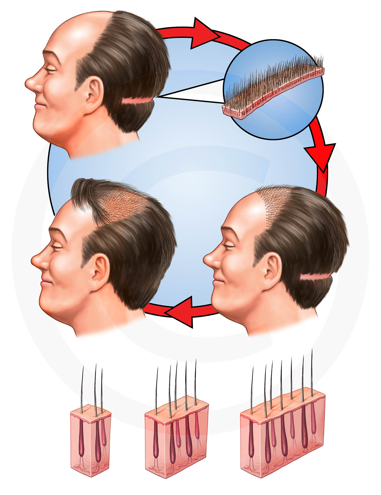 Hair Transplant : Magazine illustration.