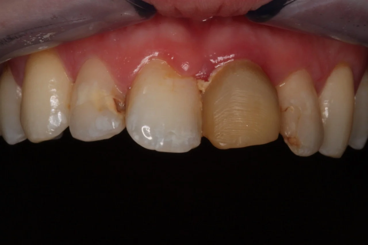 gum reshaping 1.jpg