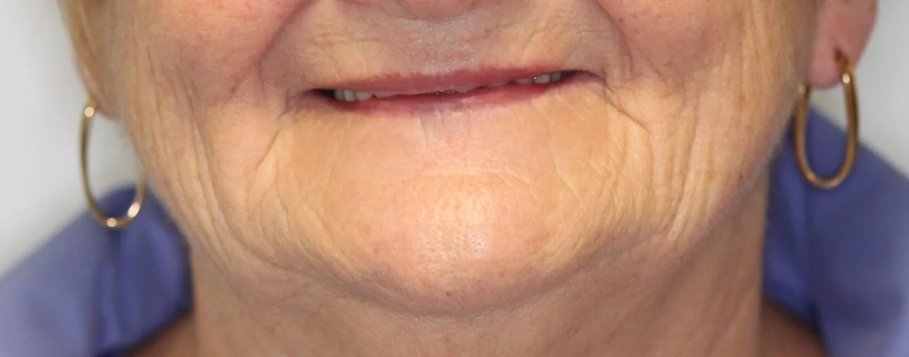 valplast flexible partial dentures 1.jpg
