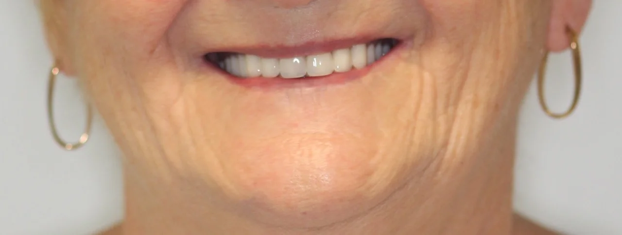 valplast flexible partial dentures.jpg