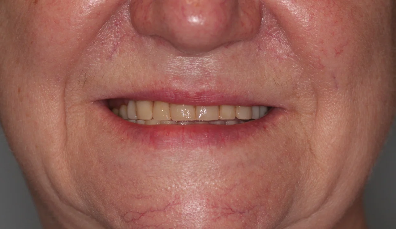 valplast flexible partial dentures 4.jpg