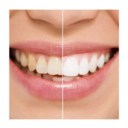 whitening before and after.jpg