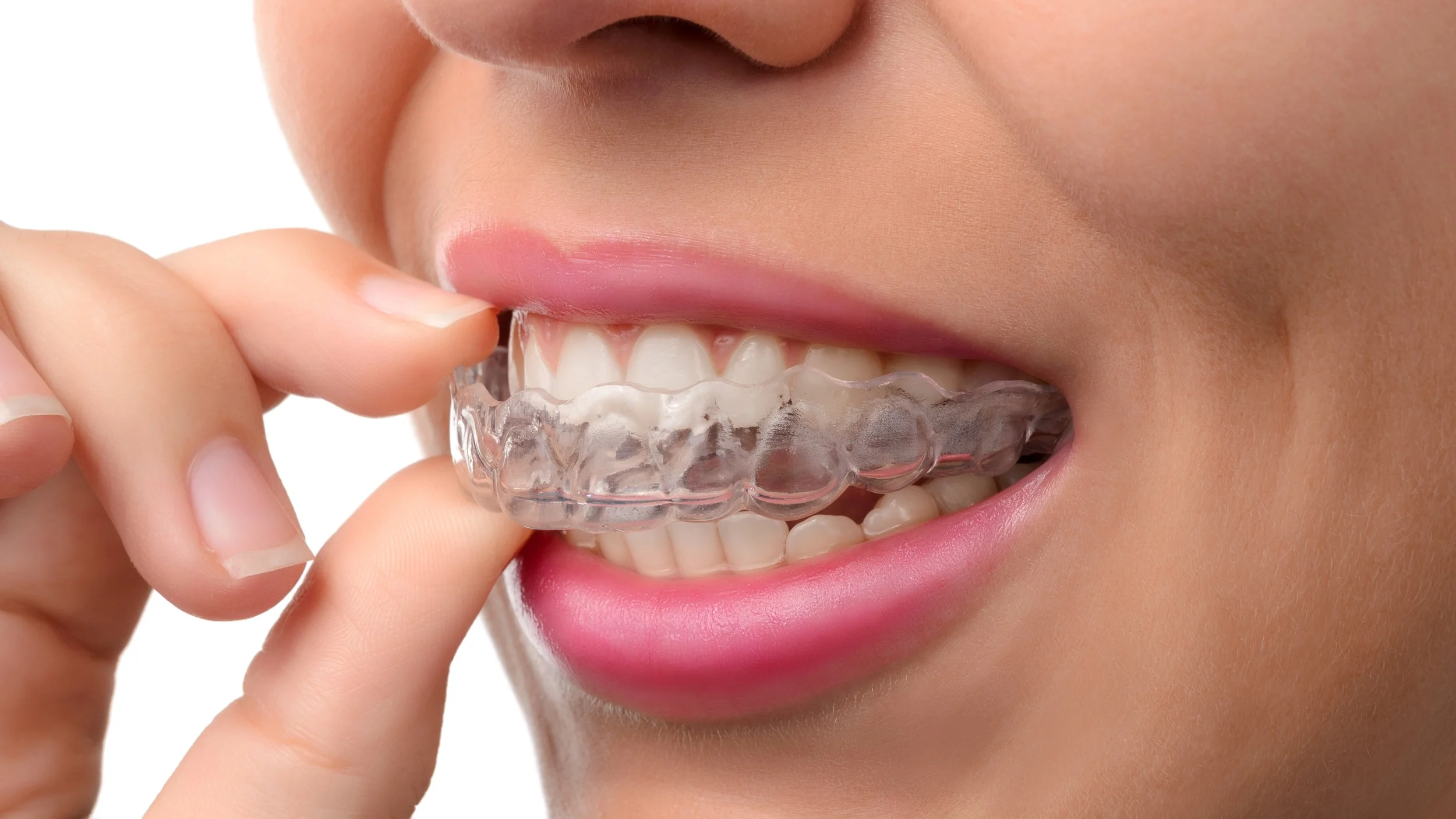 teeth straightening near me