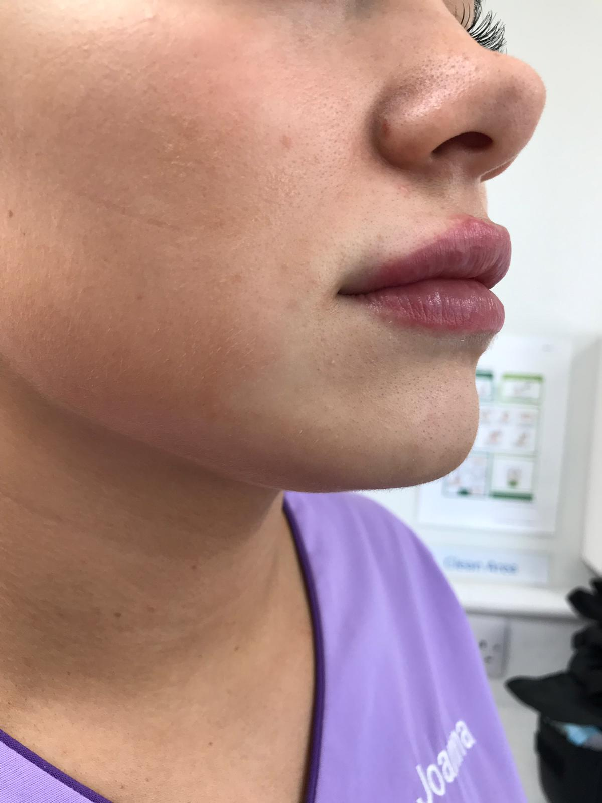 BDP_Lip_filler_2.png