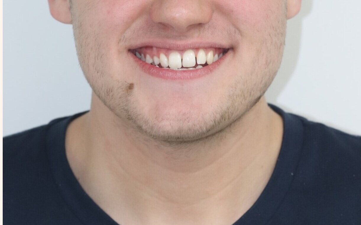 Before Treatment (Copy)