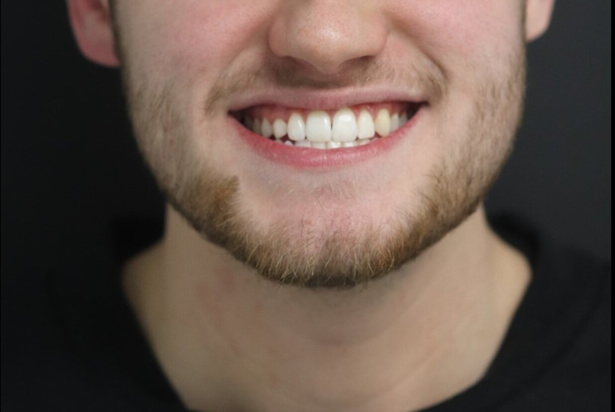 After Treatment (Copy)