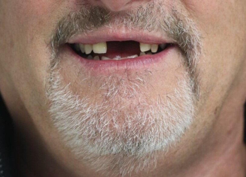 Before Treatment (Copy)
