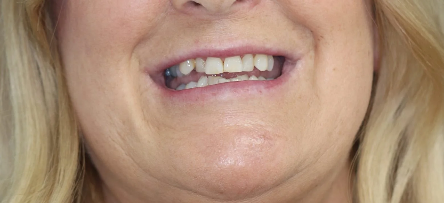 Before treatment
