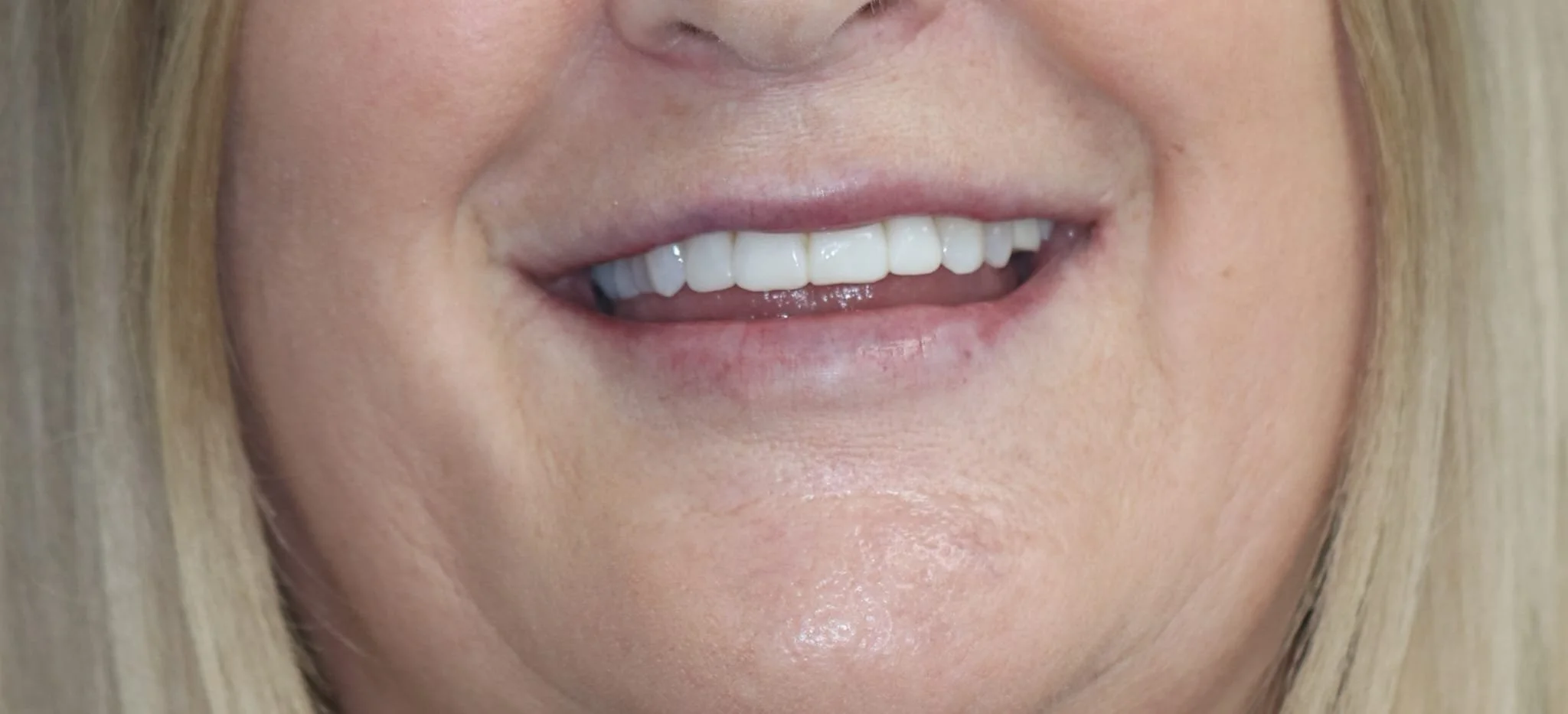 After Treatment
