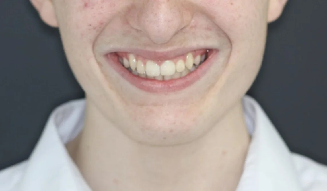 Invisalign Teen