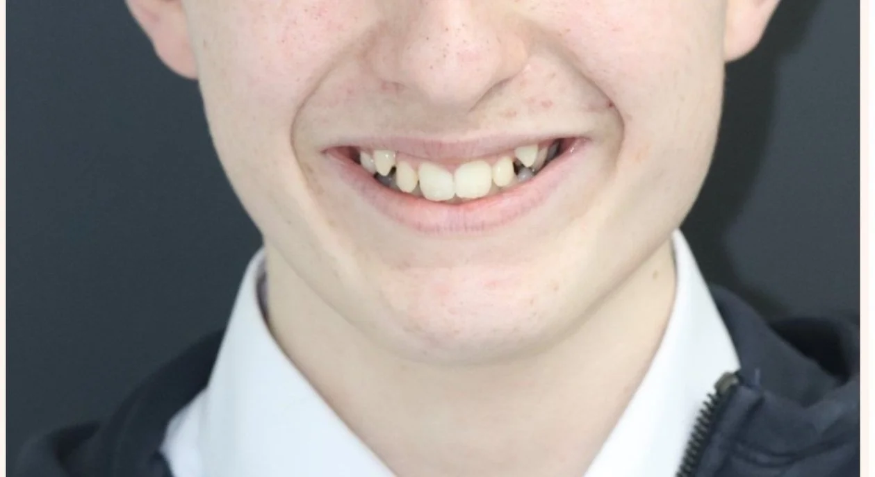 Invisalign Teen