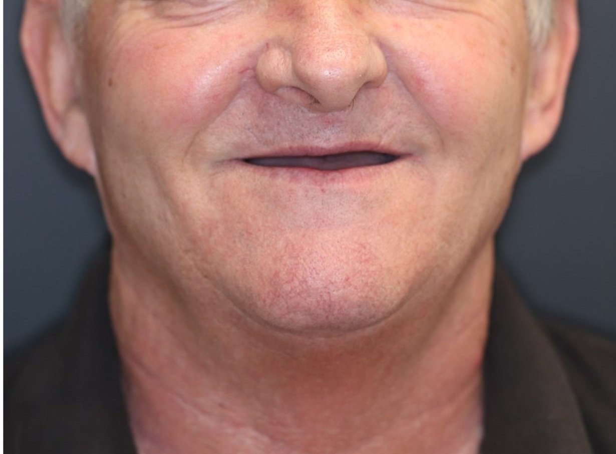 Before treatment