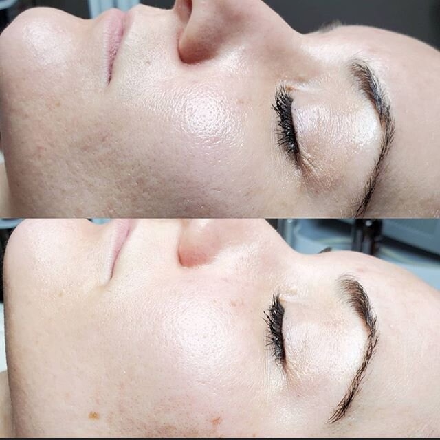 Check out these AMAZING results Andrea was able to achieve with her guest&rsquo;s skin by doing a single Rezenerate Treatment! The service is only 60 minutes with ZERO down time 👏🏻👏🏻👏🏻 Link in bio to book with Andrea!