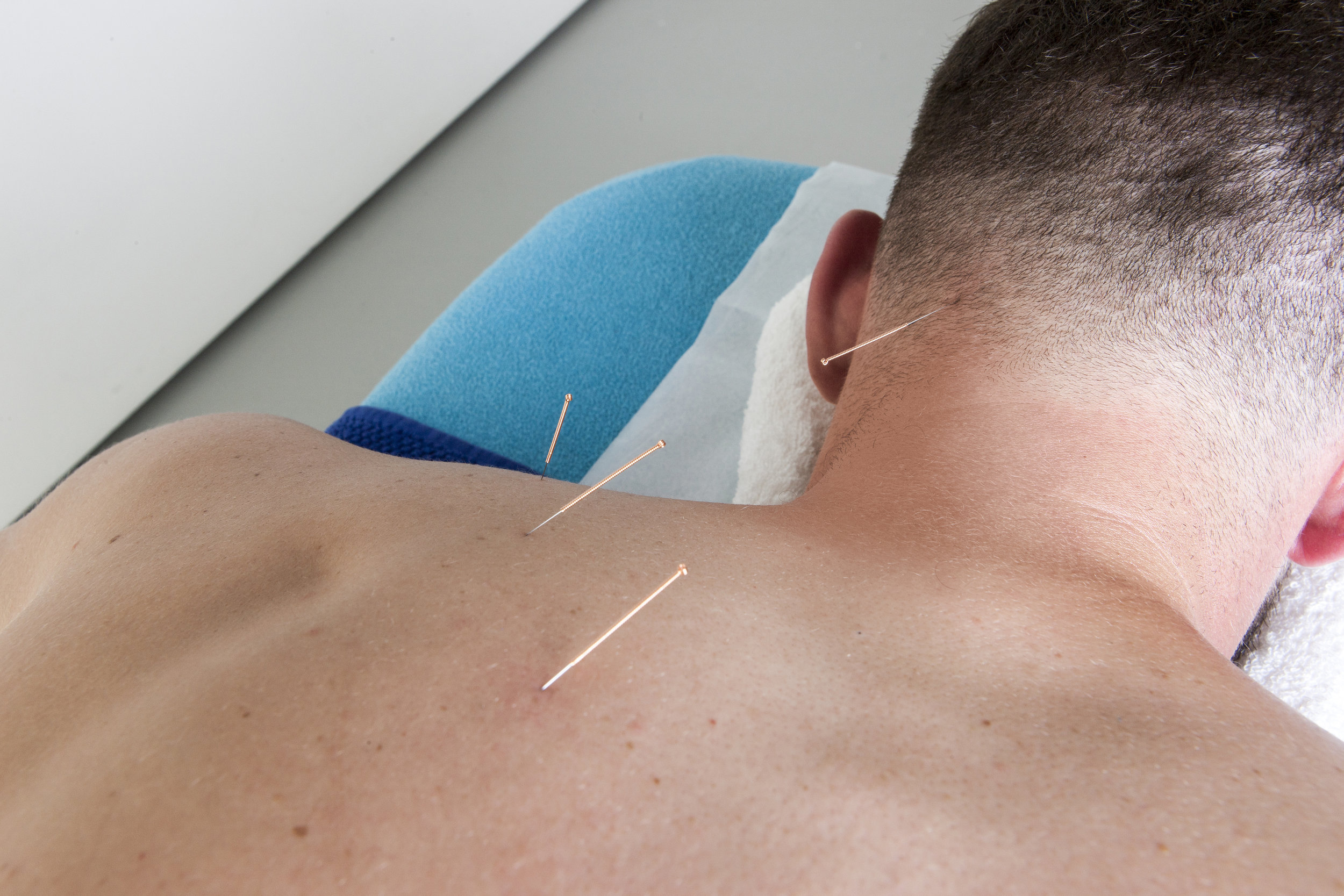 Possibility to integrate Dry Needing (Medical Acupuncture) within this treatment. Click here to read more about Dry Needling. 