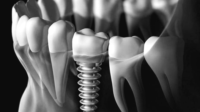 dental_implants4.jpg