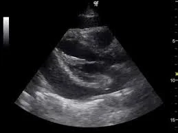 Cardiac Tamponade.jpg