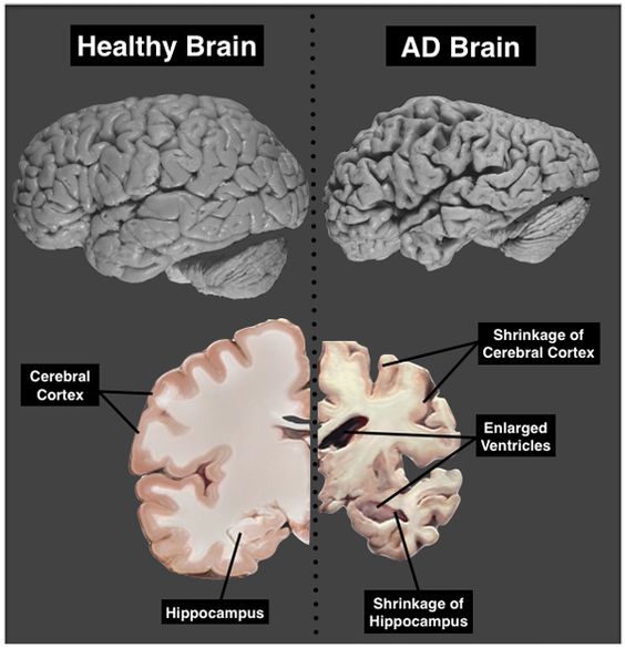 alz-compare.jpg