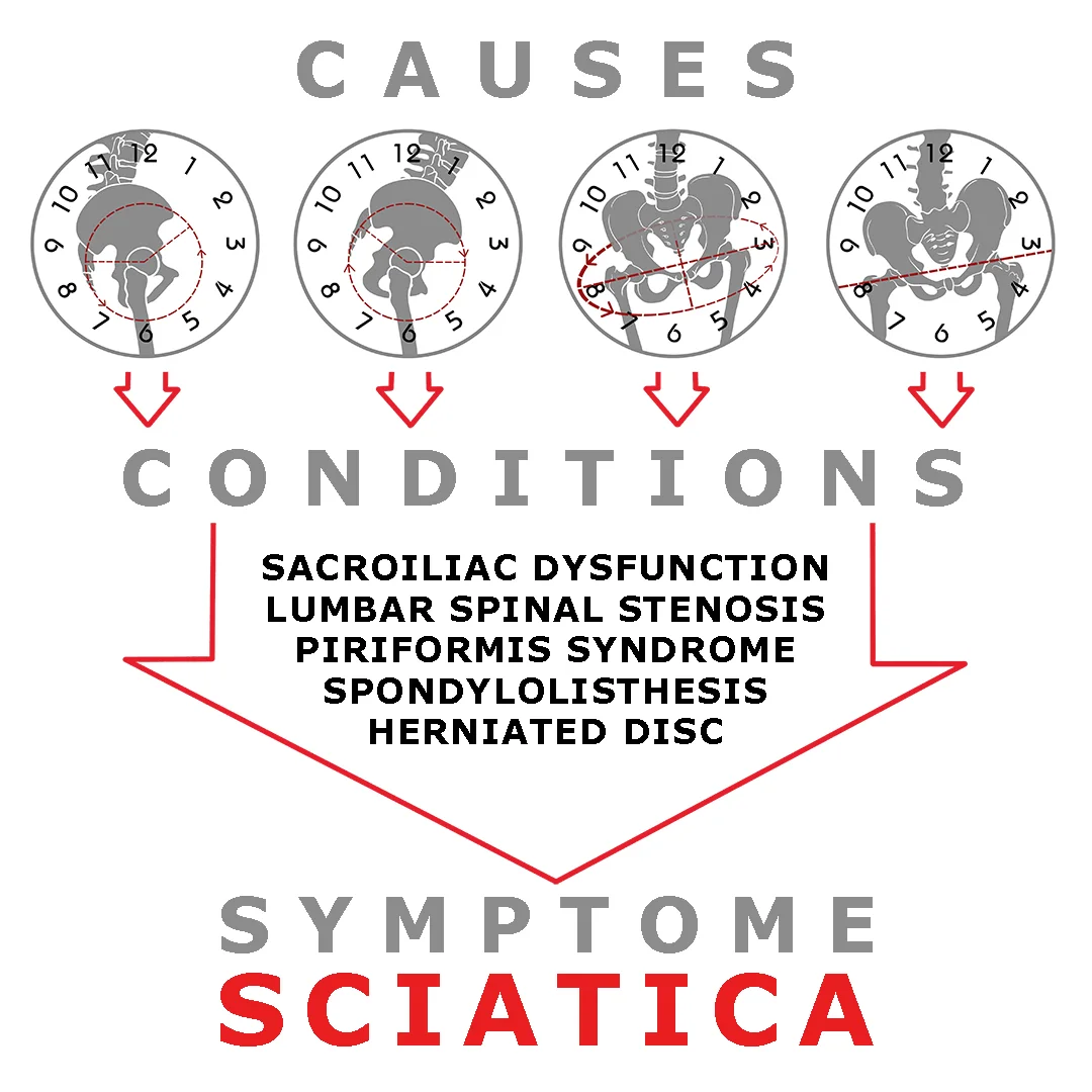 SCIATICA.jpg