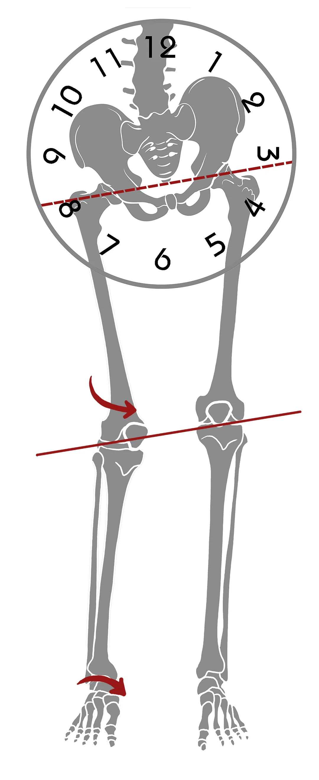 Leg Length Discrepancy / Malalignment