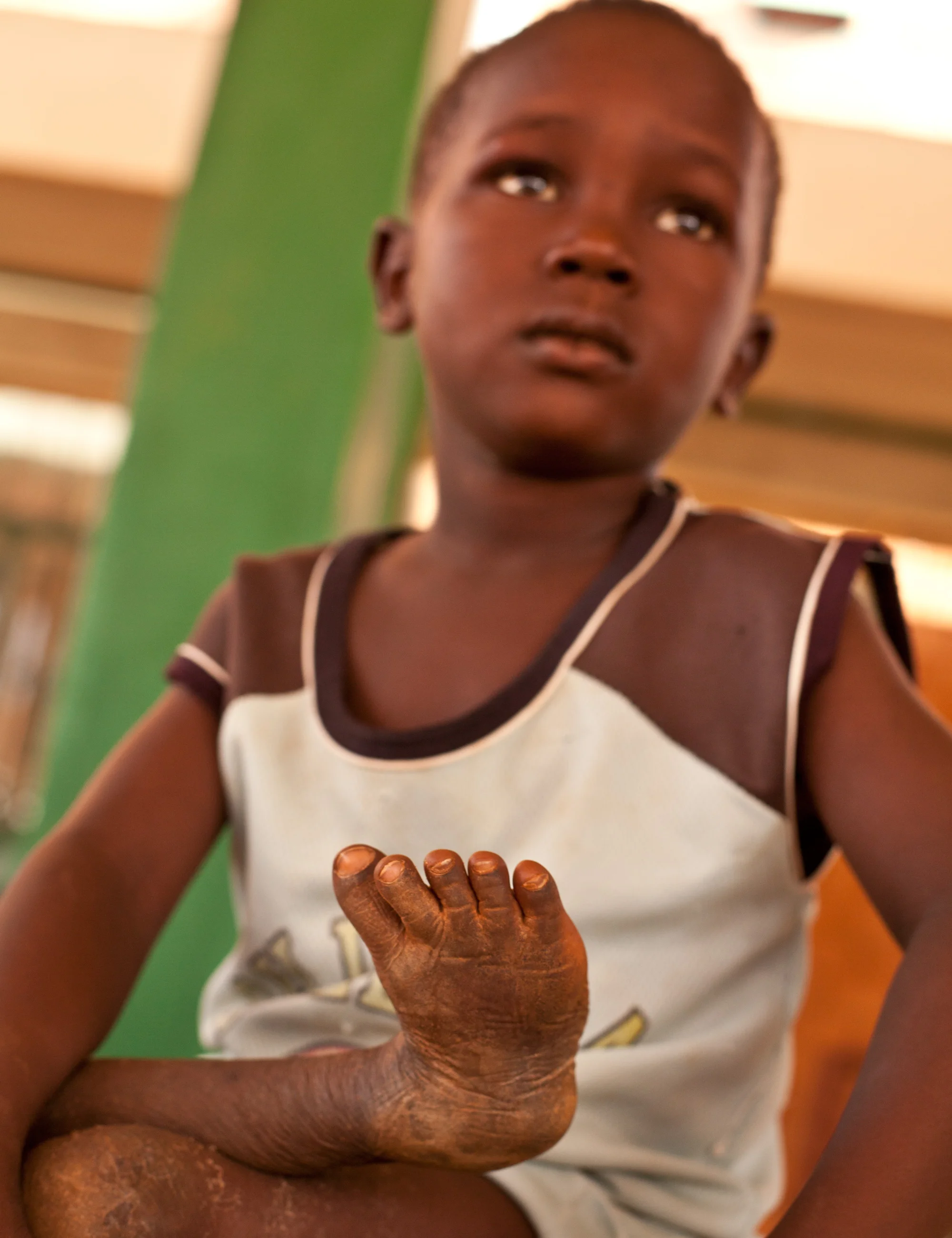 larwan-clubfoot_0742.jpg