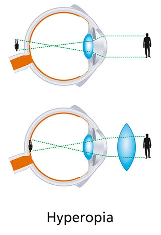 hyperopia.jpg