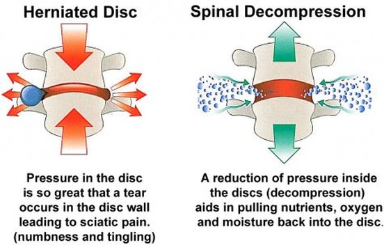 Spinal+Decompression