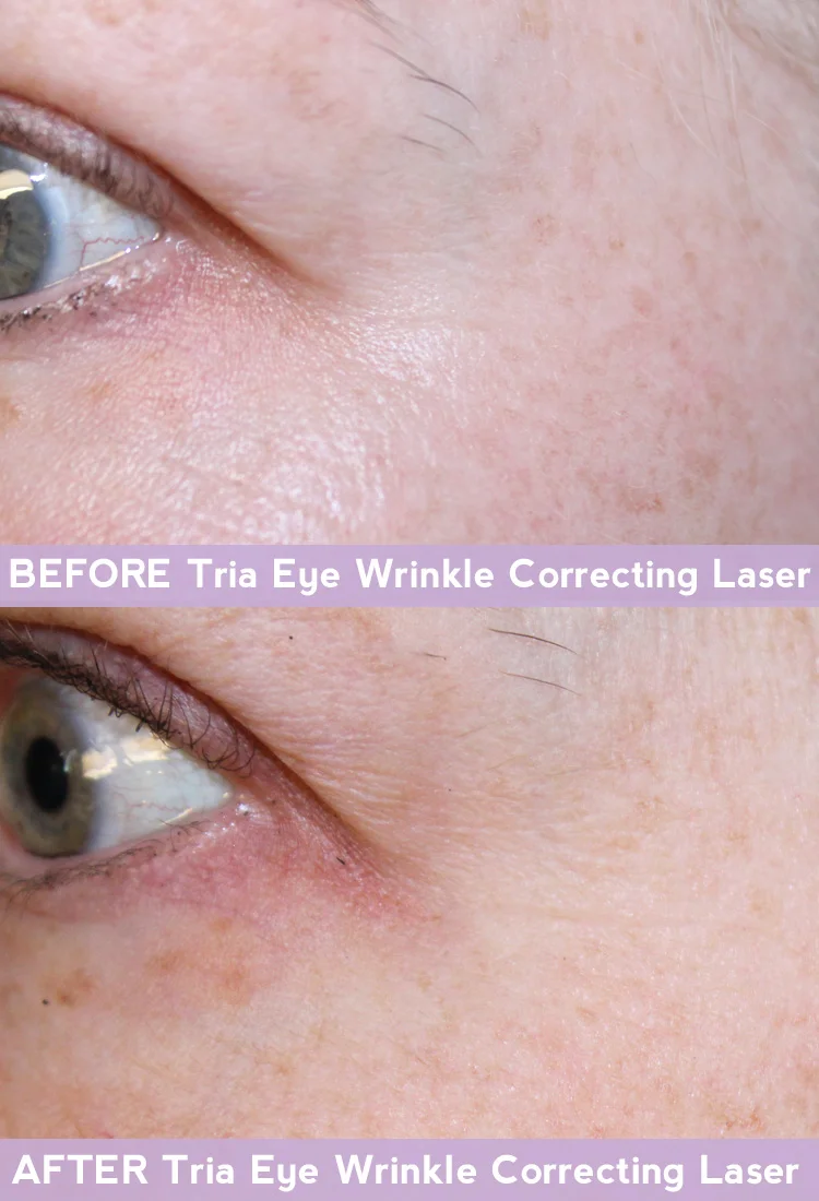 Tria Age-Defying Eye Wrinkle Correcting Laser BEFORE + AFTER