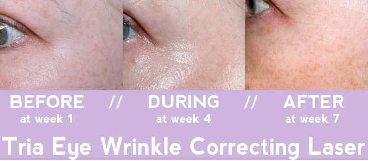 Tria Age-Defying Eye Wrinkle Correcting Laser BEFORE + AFTER
