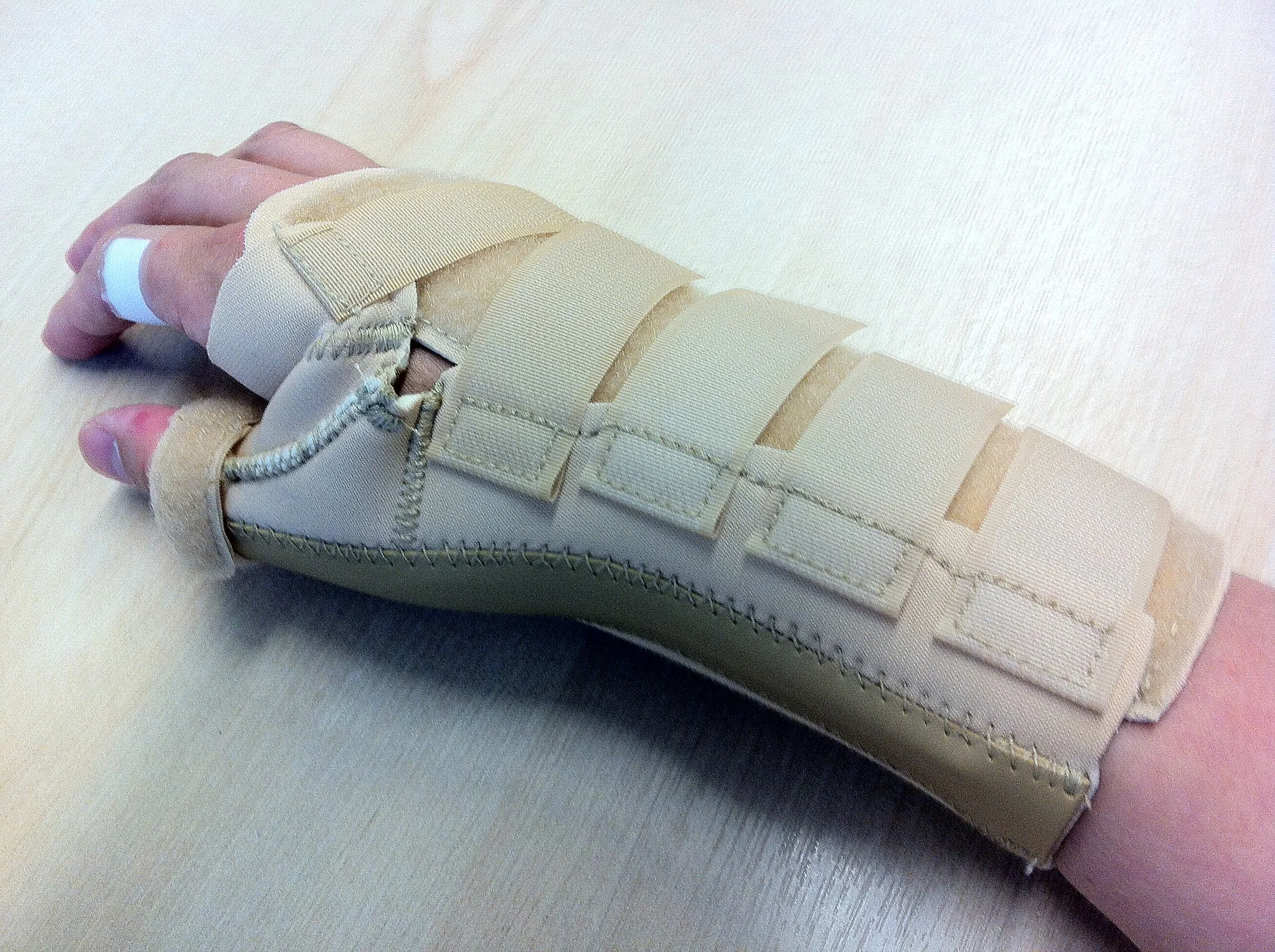 arm in splint.jpg
