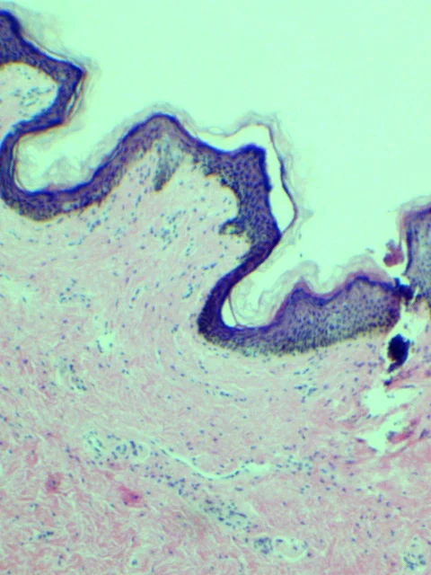 Prepuce Skin (H&E)