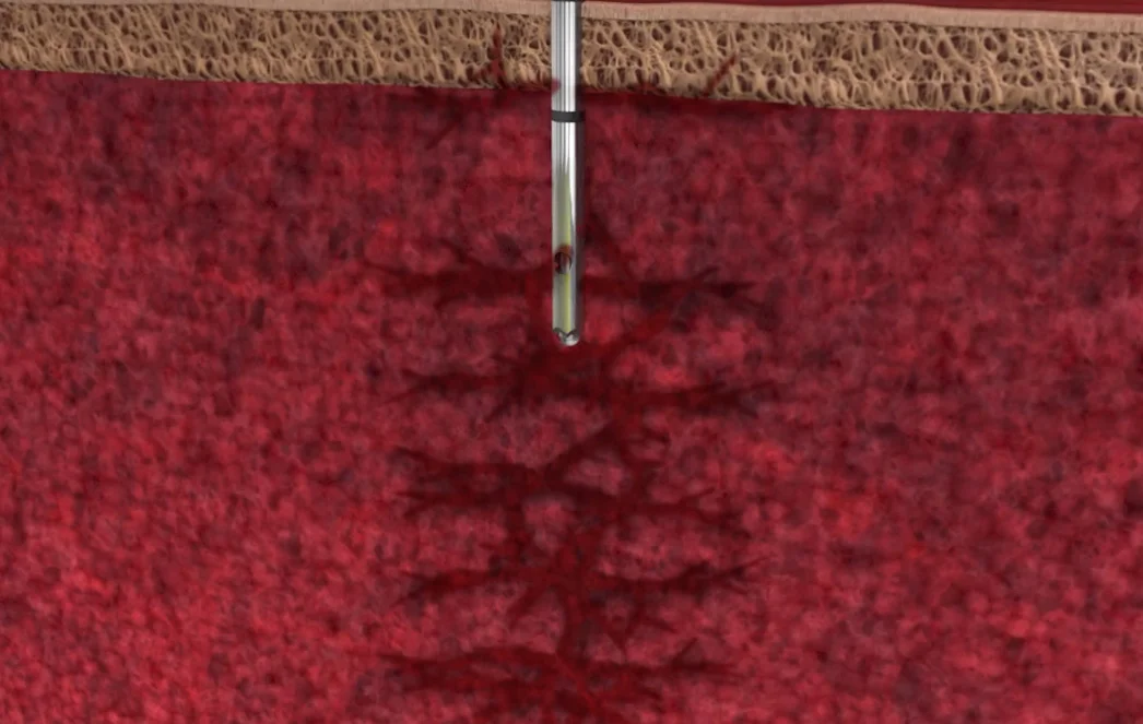 MARROW CELLUTION™ aspirates from multiple geographies while limiting peripheral blood collection.
